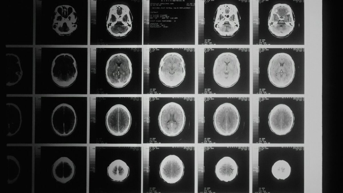 Il cervello non invecchia tutto insieme: il lato destro sembra più "vecchio"